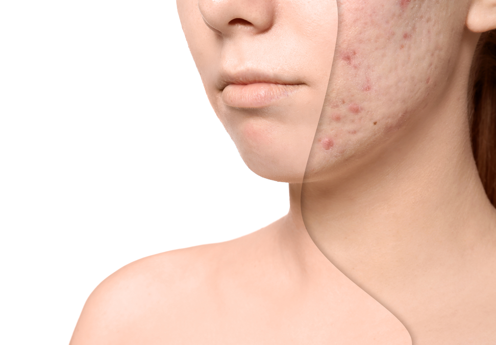 acne-scar-treatment-before-after-