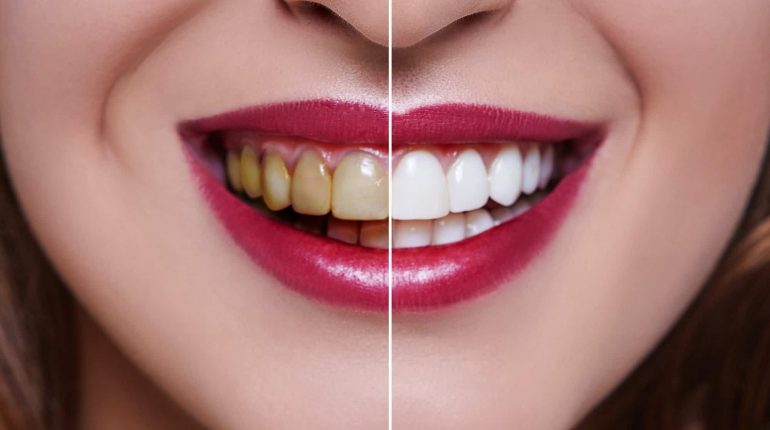 teethwhite1